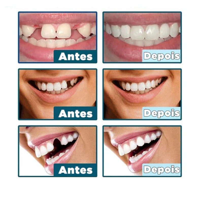 Facetas Dentárias Naturais Removíveis - Ultimo dia da Promoção